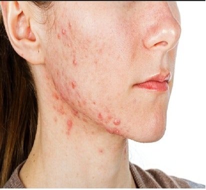 dermatitis